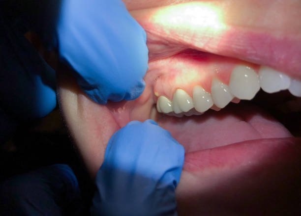 Best Knocked-Out Tooth (Avulsed Tooth) Treatment in Collinsville, VA